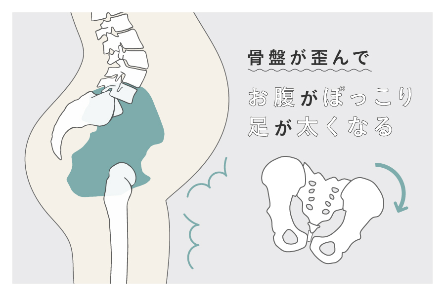 骨盤が歪んでお腹がぽっこり