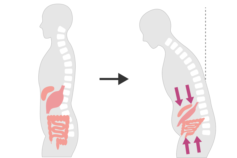 そして、行き場を失った内臓が、お腹側にぽっこりと押し出されてしまう。