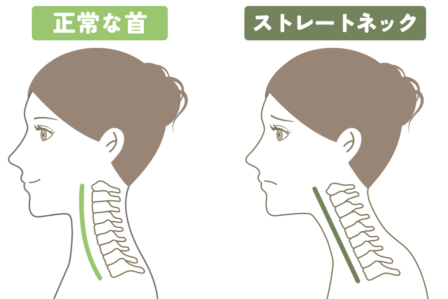 ストレートネック