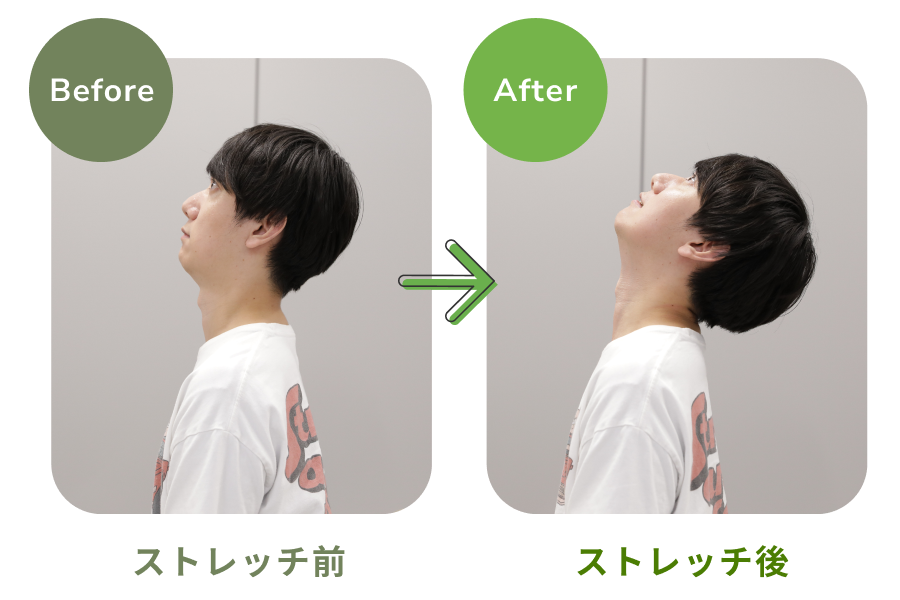 首のストレッチをした20代男性のビフォーアフター