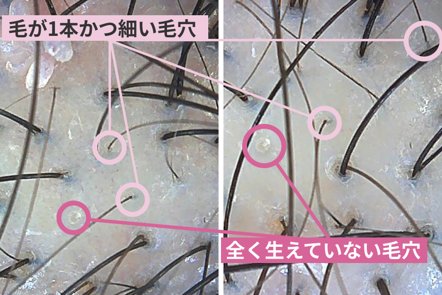本来1つの毛穴から2〜3本生えるはずの毛が1本しかなく、毛自体も細い状態。 さらに、全く生えていない毛穴まで散見されました。