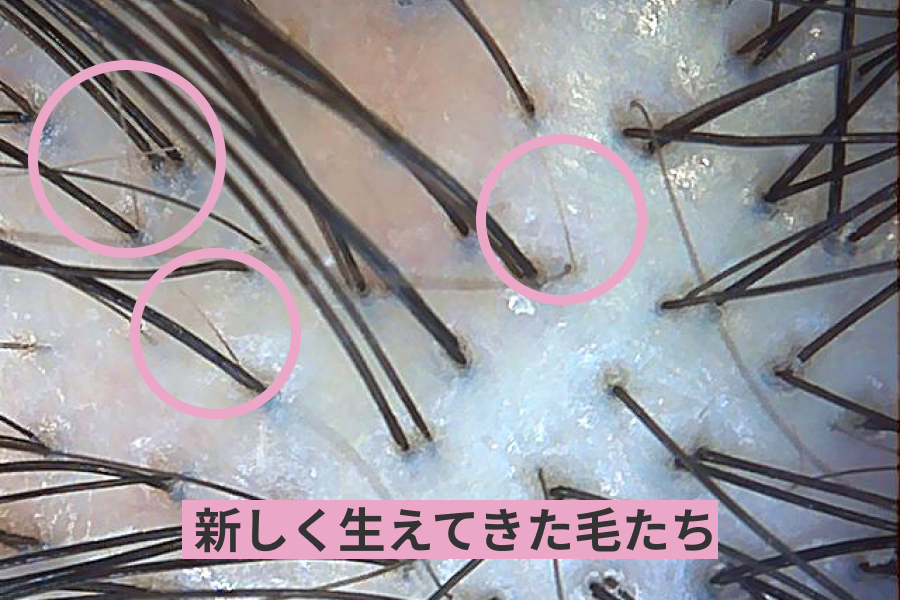 齊藤さん：なかったですね。全体的に細い毛がしっかり生えてきています。