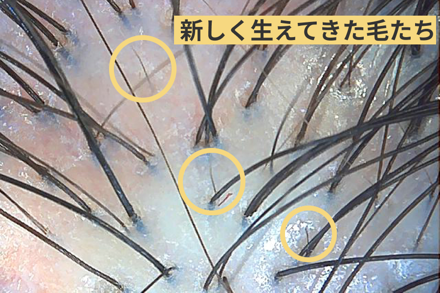 産毛がさらに生えてきた