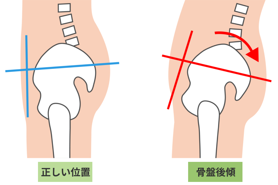 ただし放置NG！「歩幅が狭くなった」の原因は姿勢（骨盤の後傾）