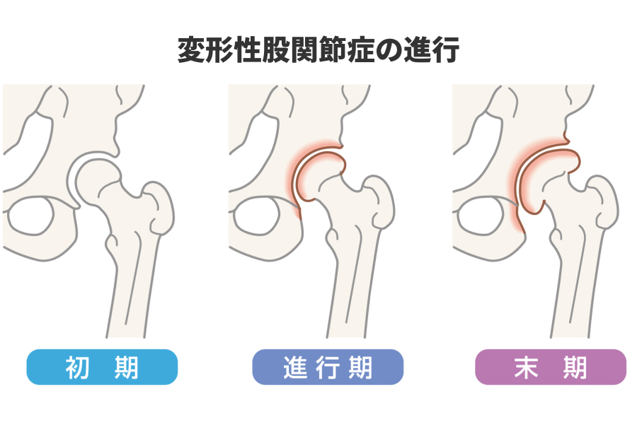 受け皿が浅いと関節が少しぐらつき、長い時間をかけて軟骨が減っていく。