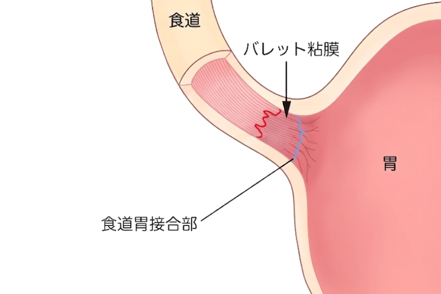 症状を放置するとがんのリスクが高まる