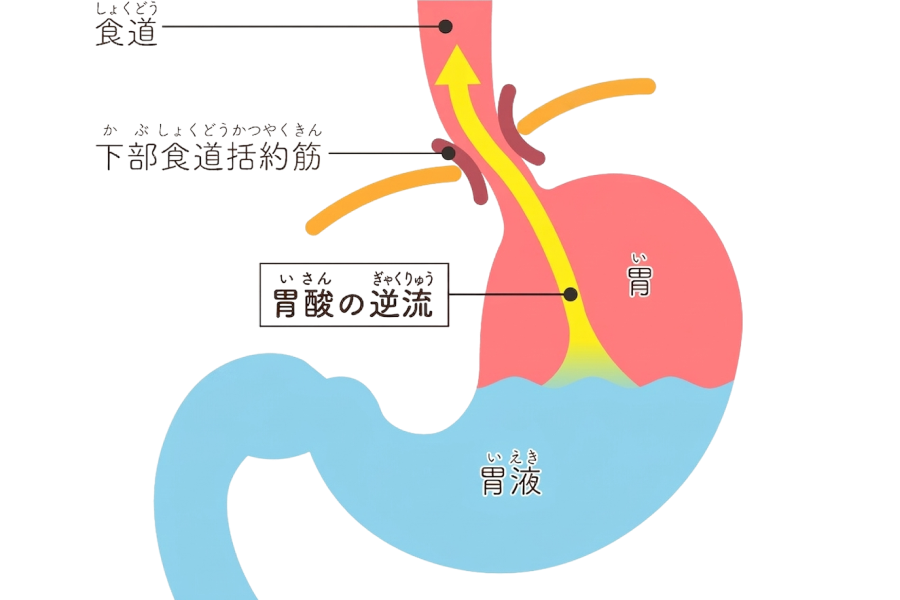 逆流性食道炎の原因｜なぜ若年層に急増している？