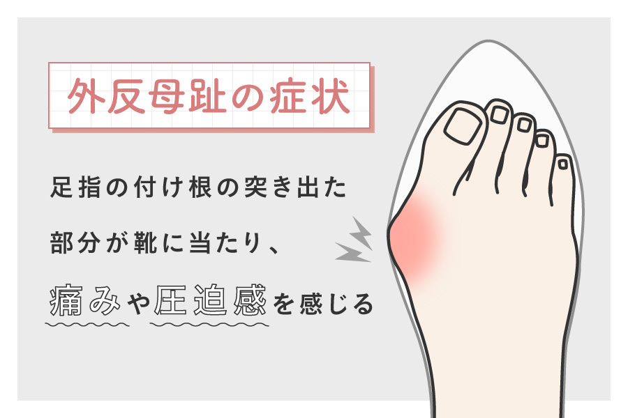 外反母趾は、足の親指が外側に向かって曲がり、足指の付け根が内側に出っ張る状態を指します。