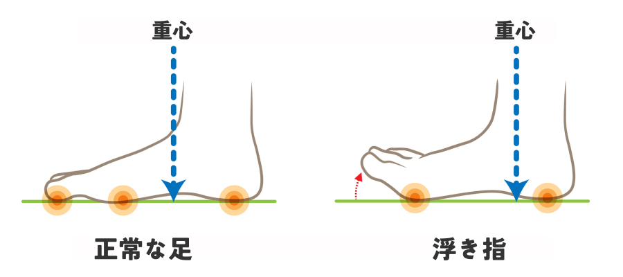 これが「浮き指」という状態